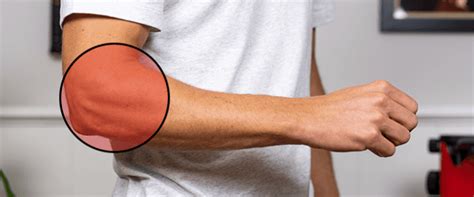 Perfect Tennis Elbow Brace Placement ~ 8-Steps + Pictures