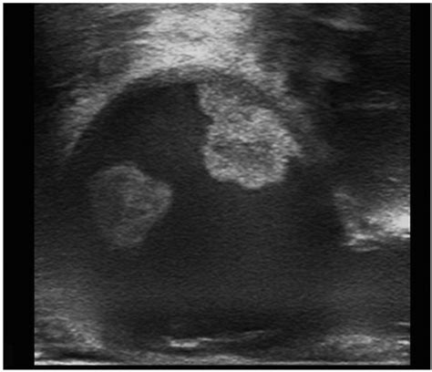 Epiaortic ultrasound revealing the presence of 2 thrombi with different ...