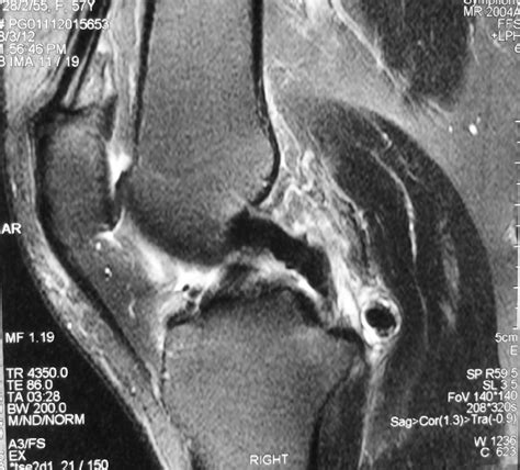 Loose Body Of The Knee Joint Hc Chang Orthopaedic Surgery Singapore