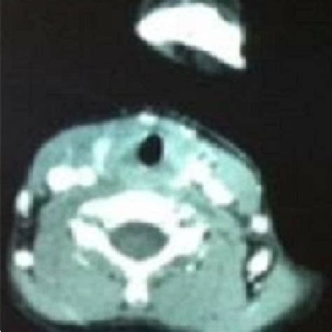 CT scan sagittal view that shows a retropharyngeal abscess with ...