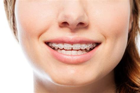 Crooked Misaligned And Gapped Teeth Platinum Smile Dentist Mandurah