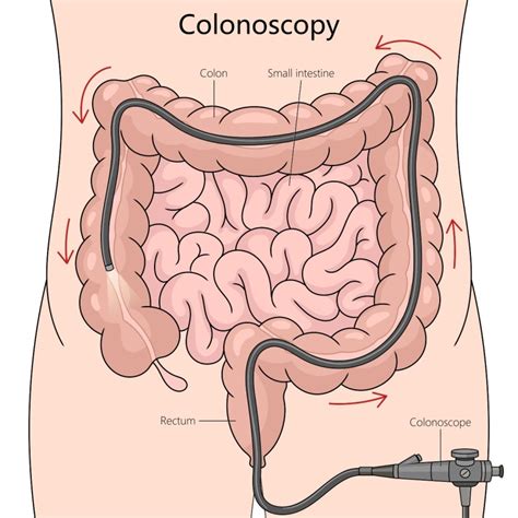 Preparazione Alla Colonscopia Come Si Fa