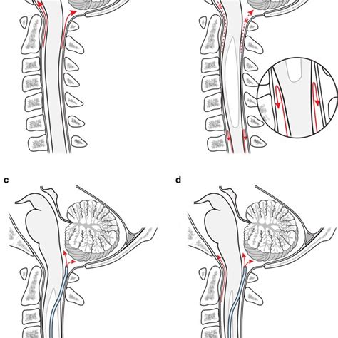 A Normal Cerebrospinal Fluid Csf Flow In The Spinal Canal B In Case Download Scientific