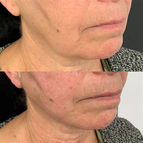 Jowls Marionette Lines Non Surgical Jowl Lift For A Defined Jawline