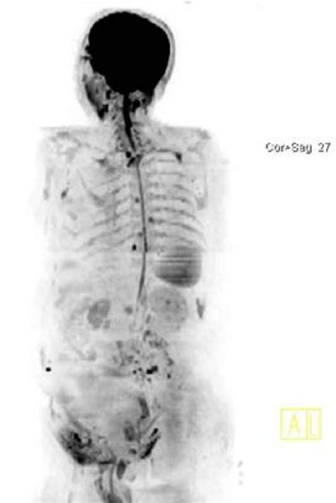 Figure 1 From Comparison Of Whole Body Diffusion Weighted Mri Wb Dwi