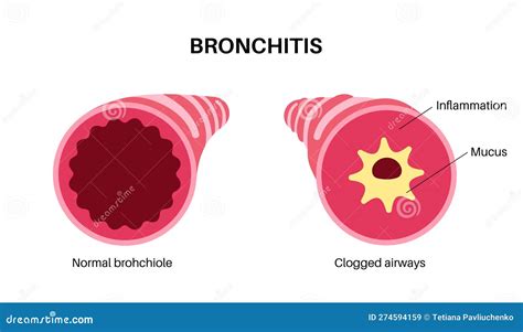 Bronchitis Lung Disease Stock Illustration Illustration Of Difficult