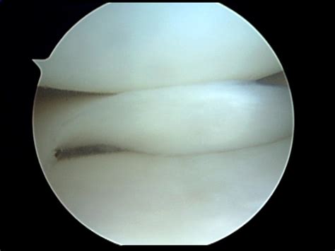 Medial meniscus tear-Displaced - Arizona Institute for Sports, Knees ...