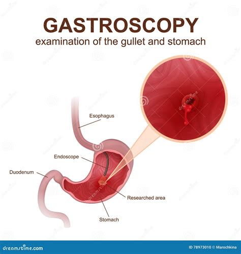 Gastroscopy procedure EGD stock vector. Illustration of digestive - 78973010