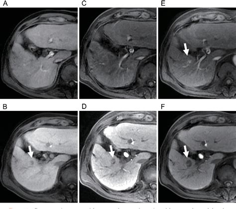 Figure From Progression Of Hepatic Hypovascular Nodules With