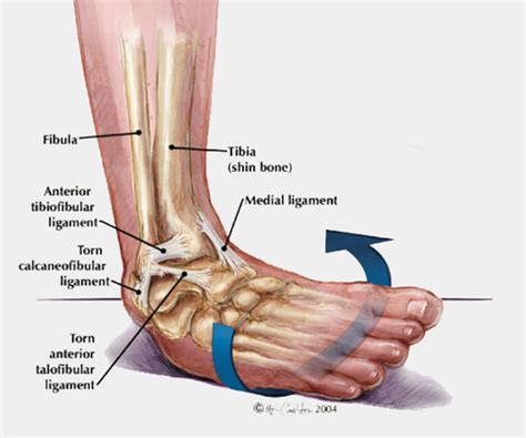 Ligament Laxity Treatment | Boston Foot Ankle Biologics