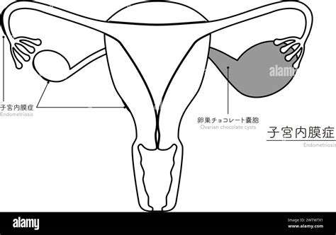 Diagrammatic Illustration Of Endometriosis Anatomy Of The Uterus And