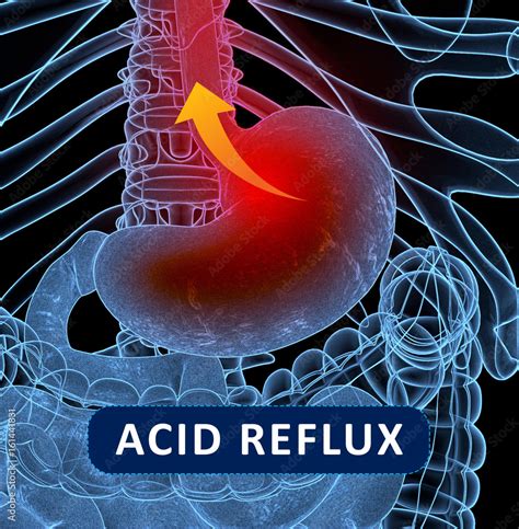 Acid Reflux Gerd Gastroesophageal Reflux Disease Diagram With Title