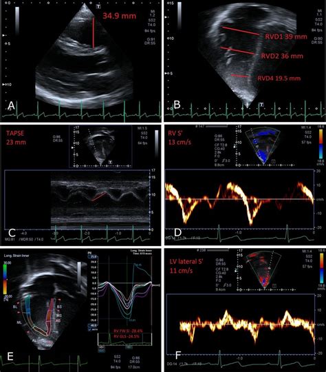 Echocardiographic Biventricular Size And Systolic Function Measurements