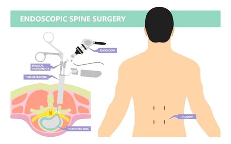 5 Benefits Of Minimally Invasive Spine Surgery Desert Spine