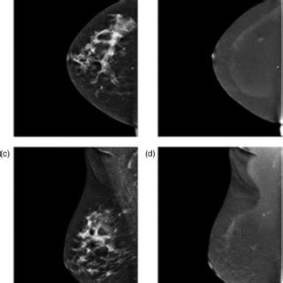 Contrast Enhanced Mammography CEM Images Of Right Breast With Two