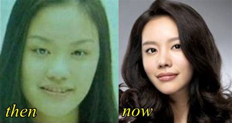 Kim Ah Joong Plastic Surgery Before And After Pictures Photos