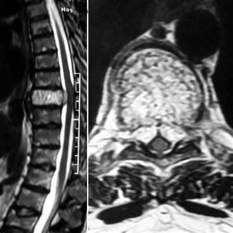 A Magnetic Resonance Imaging Of Thoracic Spine Sagittal View With Download Scientific