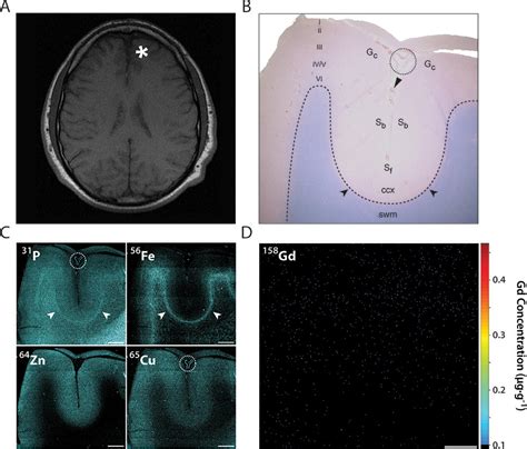 Nonhomogeneous Gadolinium Retention In The Cerebral Cortex After