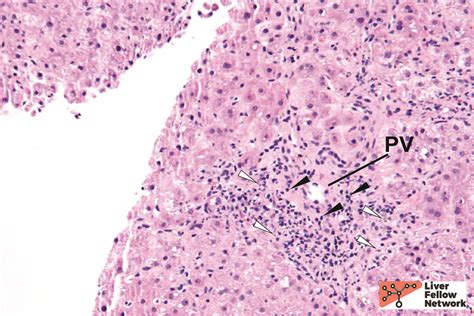 Pathology Pearls Chronic Cellular Rejection Aasld