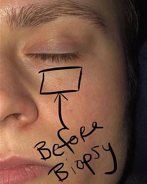 The “Pimple” Under This Woman’s Eye Turned out to Be Skin Cancer