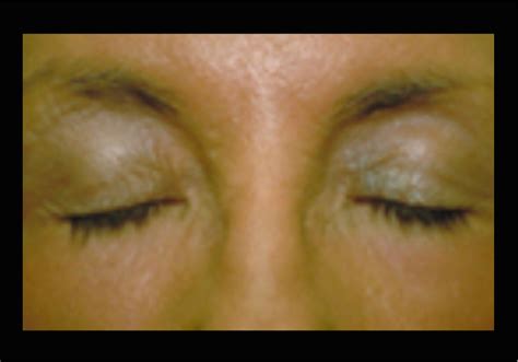 Chemical Peel 2 Post V2 Beeson Cosmetic Surgery