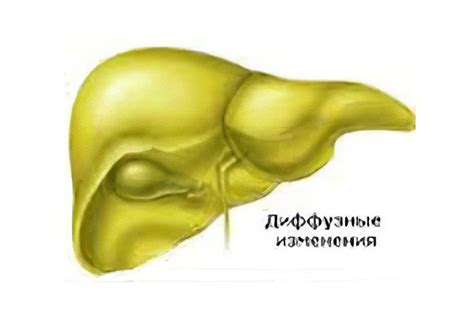 Диффузные изменения паренхимы печени