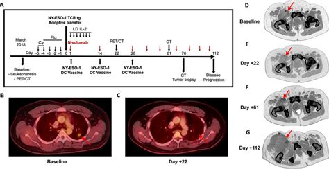 Act Of Ny Eso Transgenic T Cells And Given With Dc Vaccination And