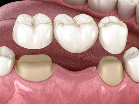 Dental Bridge Cost Procedure Types Alternatives Thrive Dental