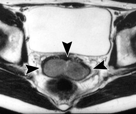 MR Imaging Of The Uterine Cervix Imaging Pathologic Correlation