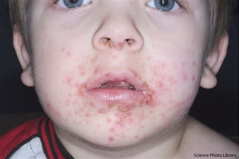 Rashes And Spots Pictures In Toddlers Children And Babies Nhs Doctor