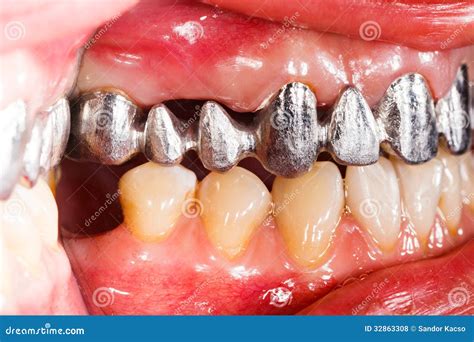 Metal Basis Dental Bridge Stock Photo Image Of Health 32863308