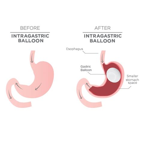 Gastric Balloon Insertion For Weight Loss Bariatric Clinic Singapore