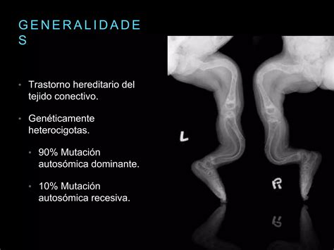 Osteogénesis imperfecta PPT