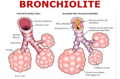 Pubblicate Le Nuove Linee Guida Per La Bronchiolite Guida Genitori