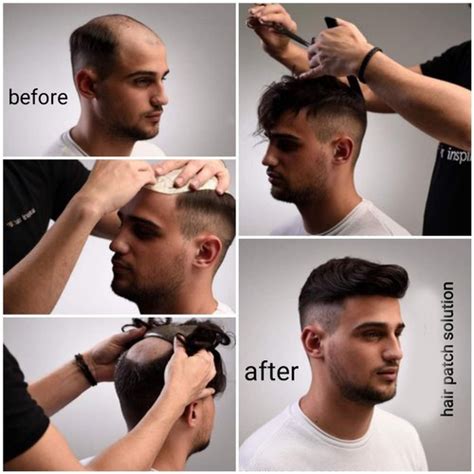 Hair Patch Best Hair Transplant And Wig Services In Patna