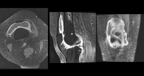 Ultimate Radiology Synovitis With Bone Infarcts In Distal Femur