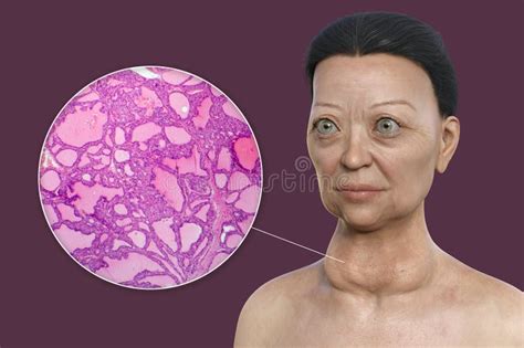 A 3d Illustration Of A Woman With Graves Disease Alongside A Micrograph