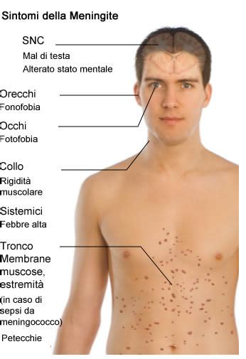 Meningite E Sepsi Da Meningococco