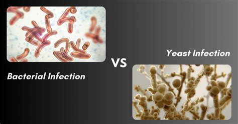 Bacterial Vaginosis Discharge Vs Yeast Infection Discharge