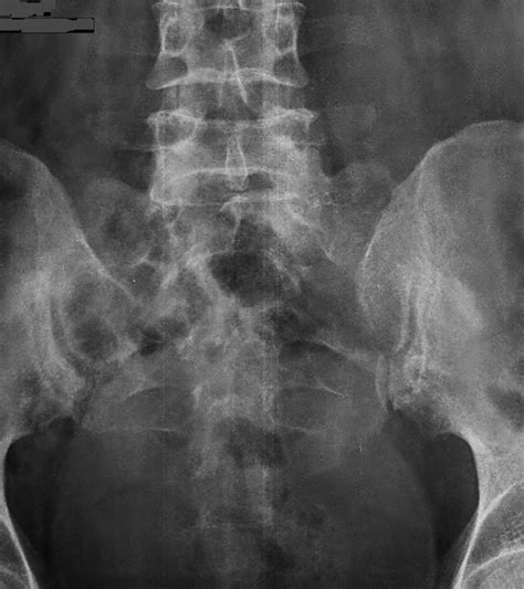 Stress Fracture Sacrum -Case Discussion - Sumer's Radiology Blog