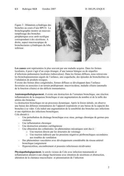 La Dilatation Des Bronches Ou Bonchectasies