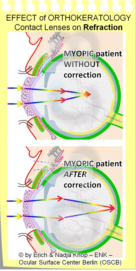 Orthokeratology Contact Lenses — Ocular Surface Center Berlin