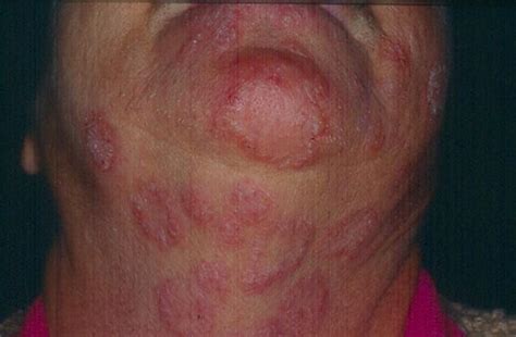 Tinea Infections As Related To Fungal Infections Pictures