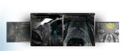 Ct计算机断层扫描软件 Mim Symphony Ldr™ Mim Software 核磁共振mri 用于dicom 3d 可视化