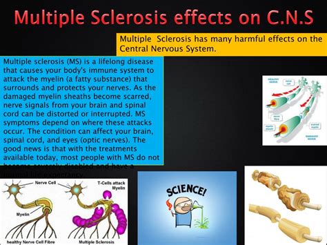 Ppt Multiple Sclerosis Powerpoint Presentation Free Download Id