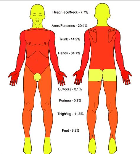 -Body map showing proportion of burn injuries in each anatomical area | Download Scientific Diagram