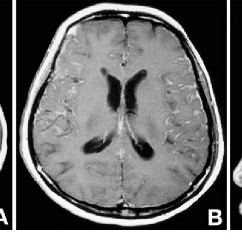 A B Axial T Weighted Magnetic Resonance Mr Images With