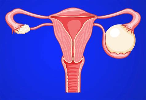 Conozca los síntomas riesgos y tratamientos de los quistes ováricos