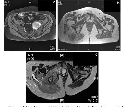 Figure 1 From Oncological Outcome Of Patients With Deeply Located Soft