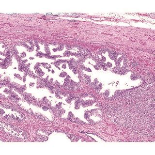 A 62 Year Old Patient With Two Prostate Cancer Tumor Foci In The Right